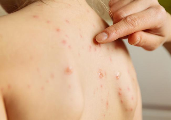 Улаанбурхан өвчний нийт батлагдсан тохиолдол 13485 болжээ