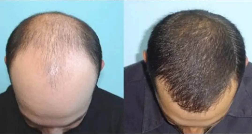 Тайванийн эрдэмтэд үс ургуулах ургамлын гаралтай шинэ бэлдмэл бүтээлээ